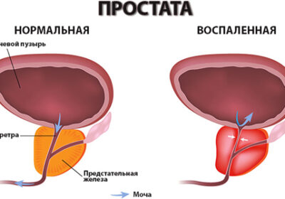 Берут ли в армию с хроническим простатитом